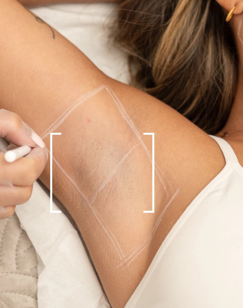 Excessive Sweating Underarms