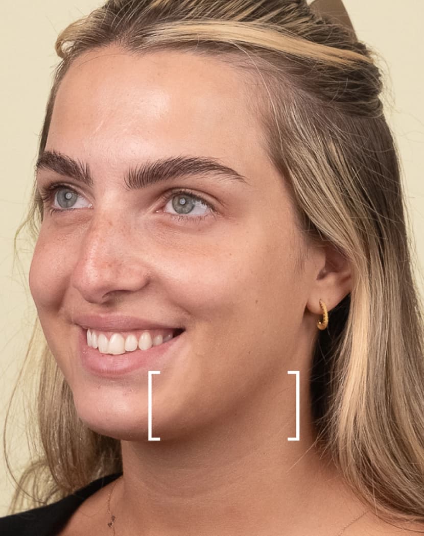 Jawline Slimming
