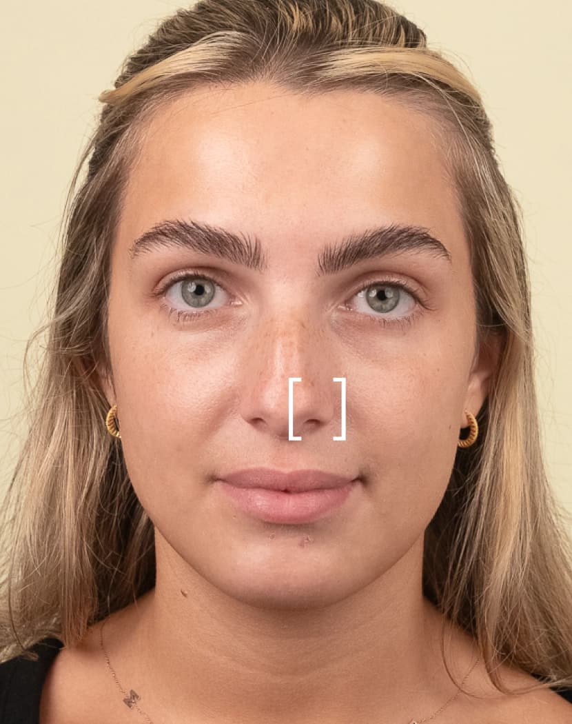 Nose Flare