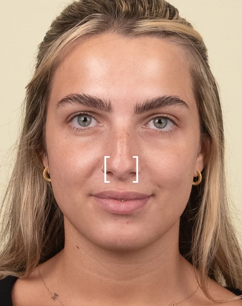 Nose Tip Lift