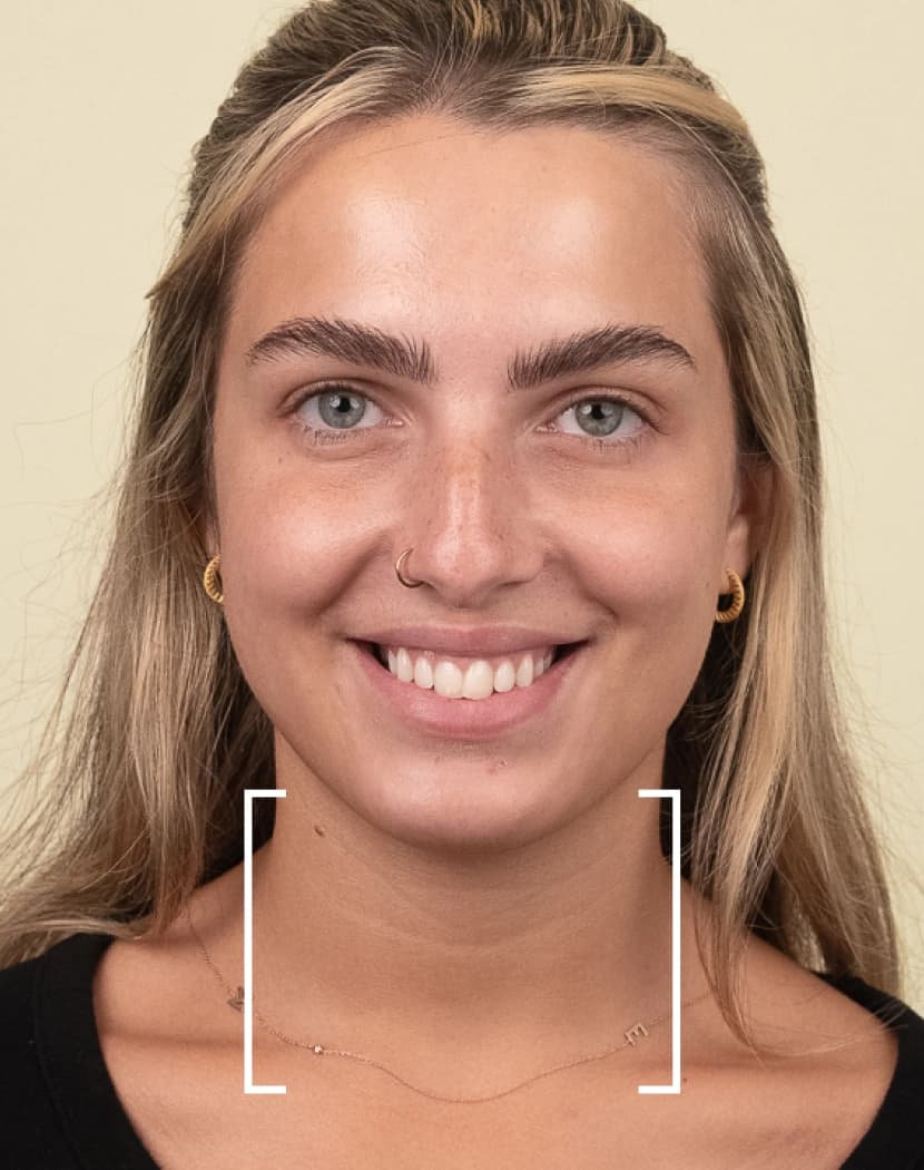 Platysma Bands