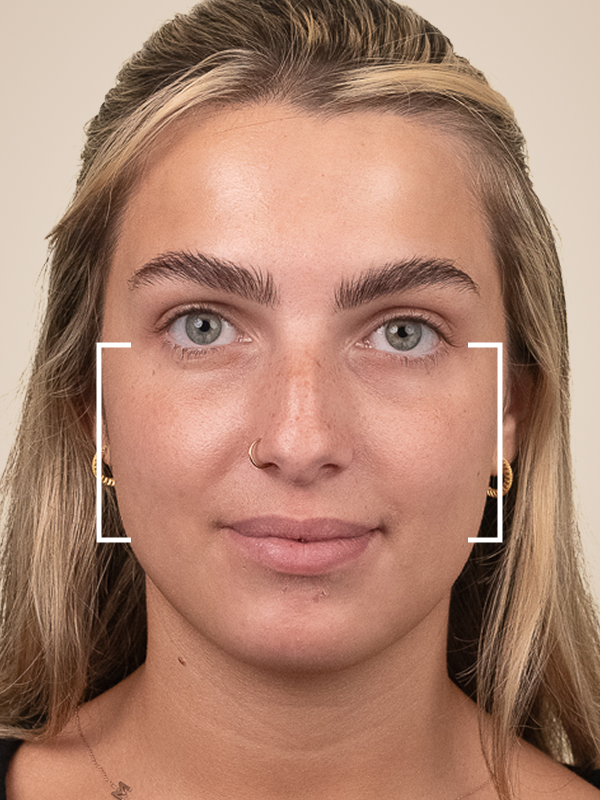 Cheek Dermal Fillers