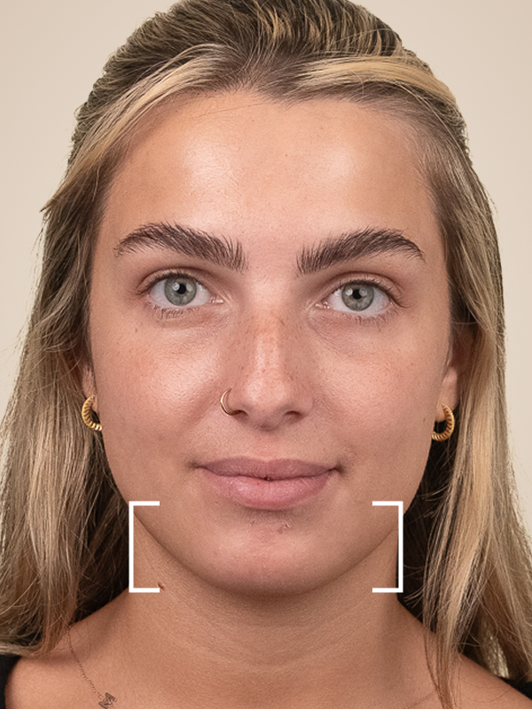 Chin Dermal Filler