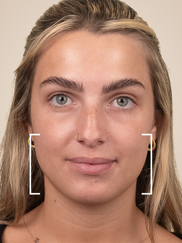 Dermal Fillers for Jowls