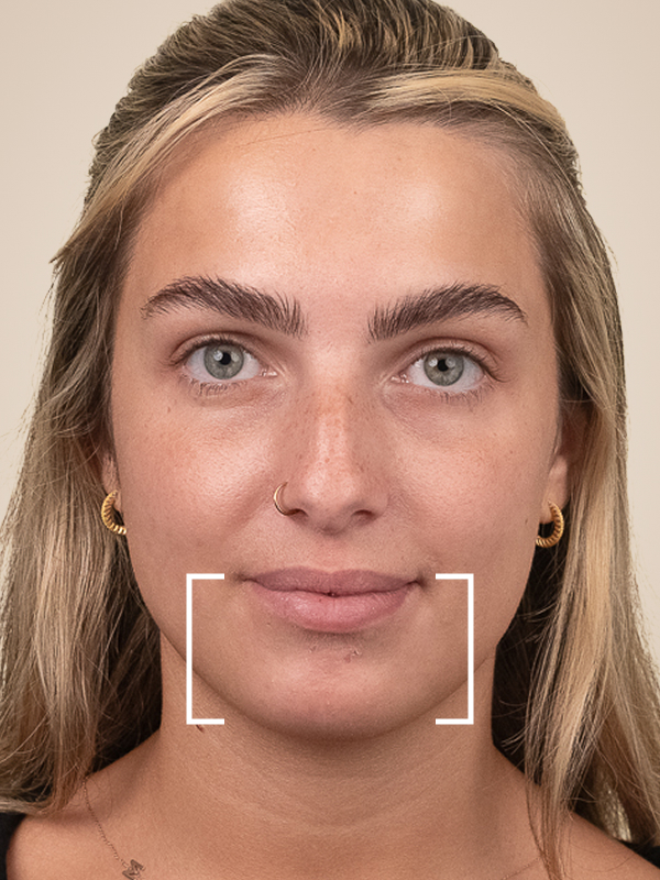 Dermal Fillers for Marionette Lines
