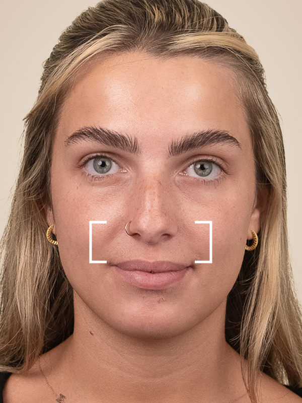 Dermal Fillers for Nasolabial Folds