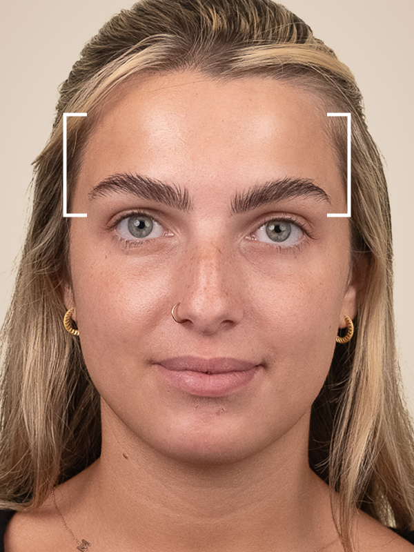 Temple Dermal Filler