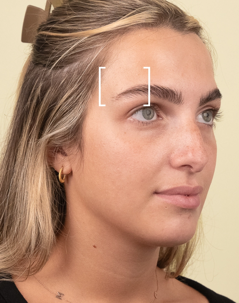 Brow Lift Brow Lift