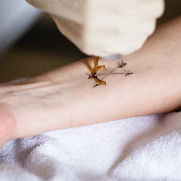 How Does Laser Tattoo Removal Work? How Does Laser Tattoo Removal Work?
