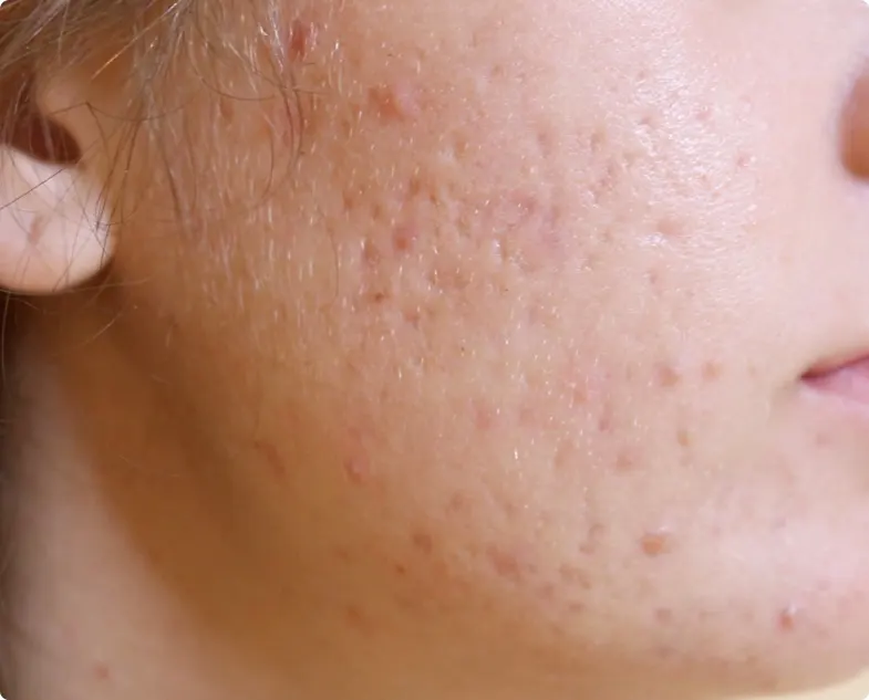 What is Acne Scarring? What is Acne Scarring?