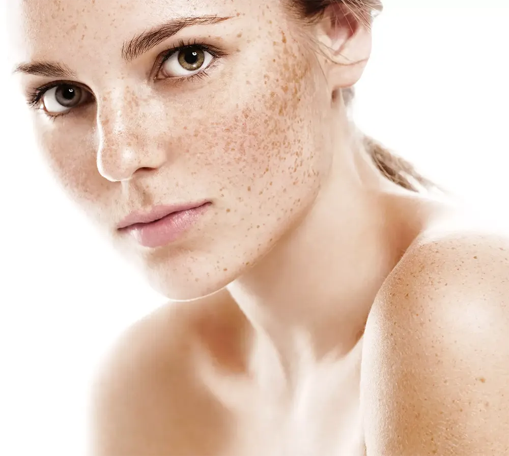 Pigmentation And Sun Damage | Thérapie Clinic