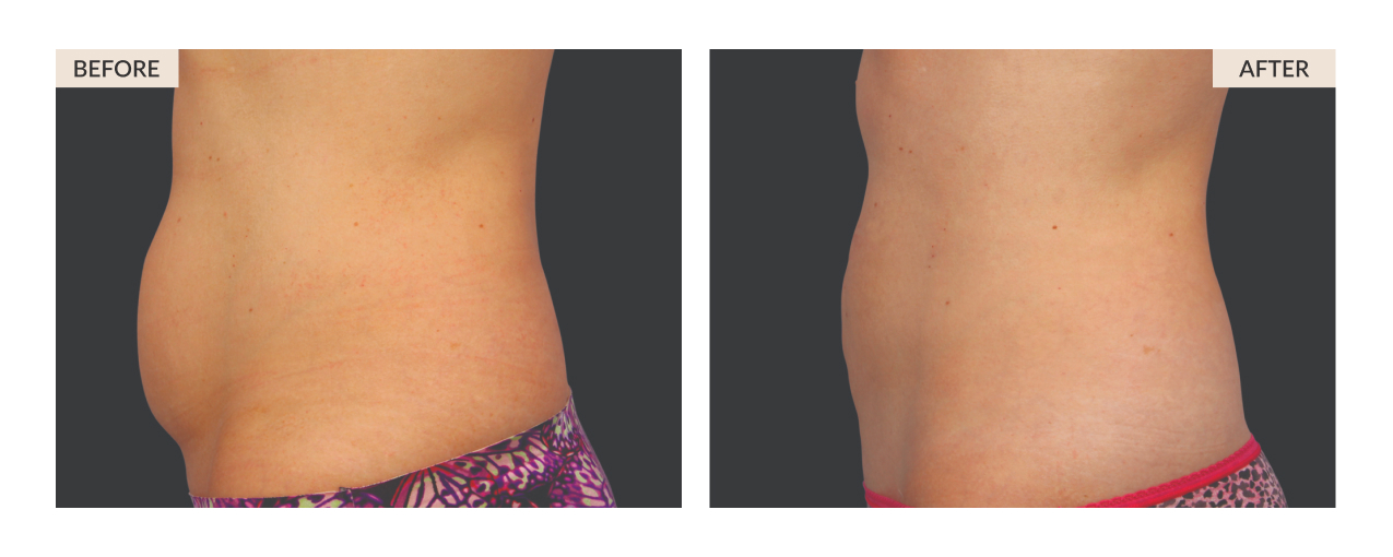CoolSculpting Stomach/Abdomen – Before and After, Reviews, Cost